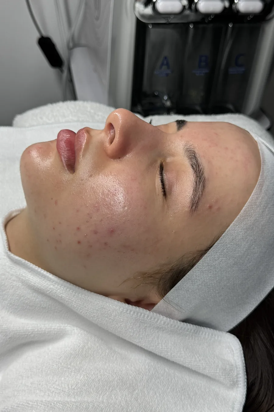 Dieselbe Wange nach dem Microneedling