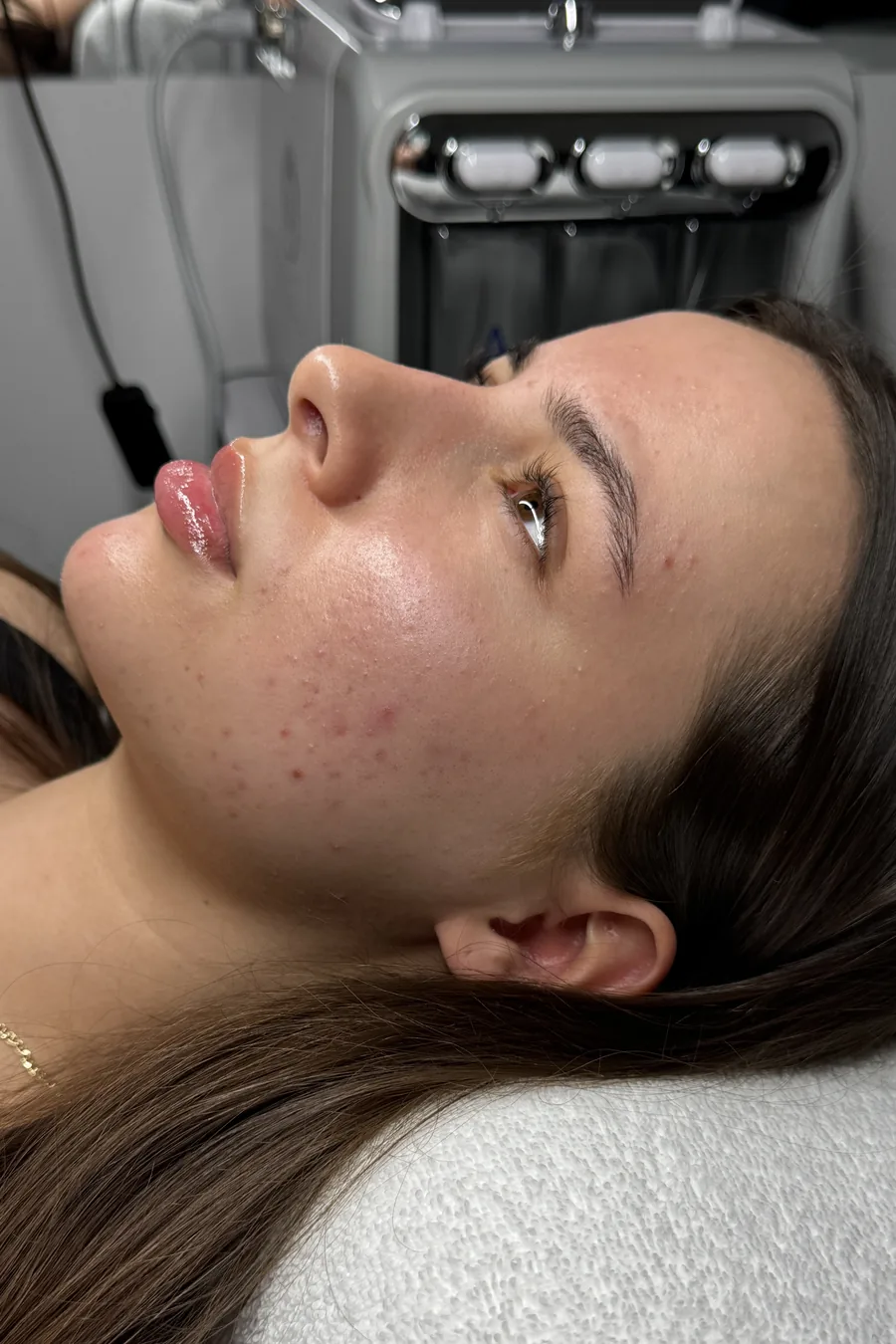 Wange einer Kundin mit Unreinheiten vor dem Microneedling